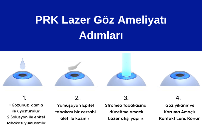 PRK Lazer Göz Ameliytaı