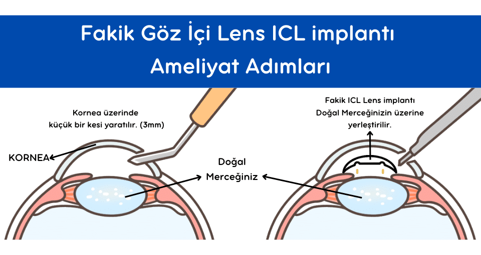 Fakik Göz İçi Lens, ICL Lens