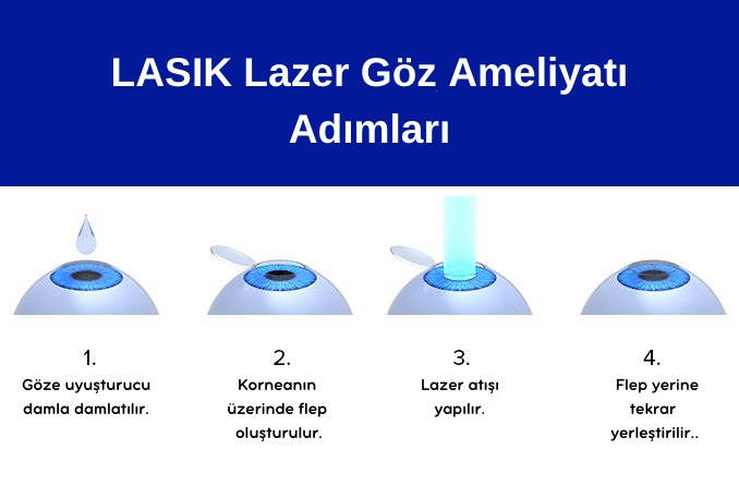 LASIK, LASIK Ameliyatı, Q-LASIK